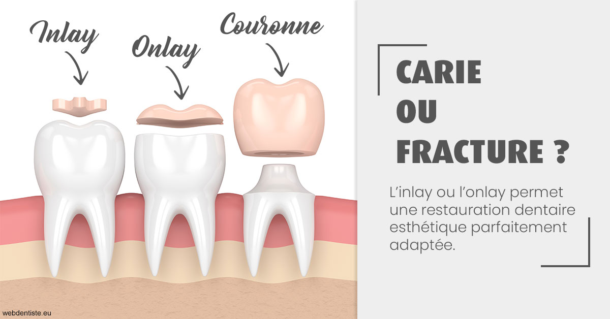 https://www.cabinetorthodontie.fr/T2 2023 - Carie ou fracture 1