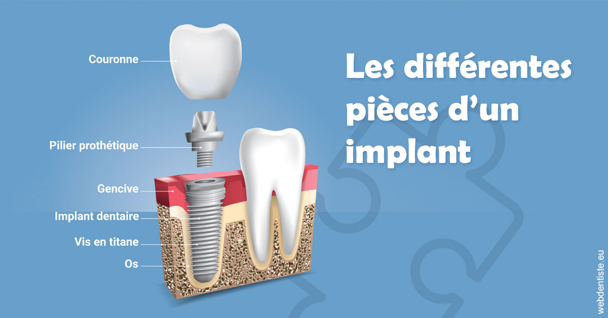 https://www.cabinetorthodontie.fr/Les différentes pièces d’un implant 1