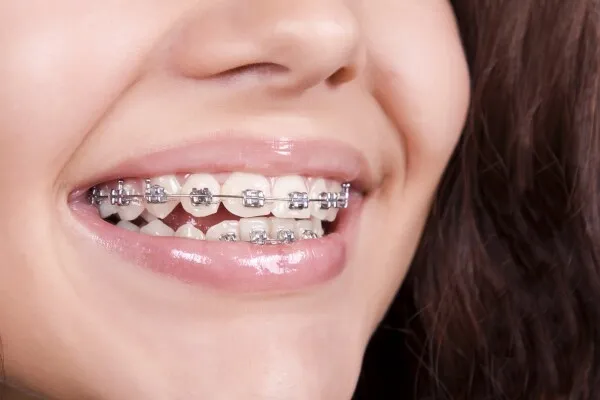 Appareils orthodontiques autoligaturants