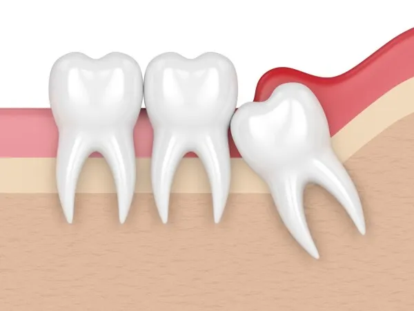 Dents de sagesse