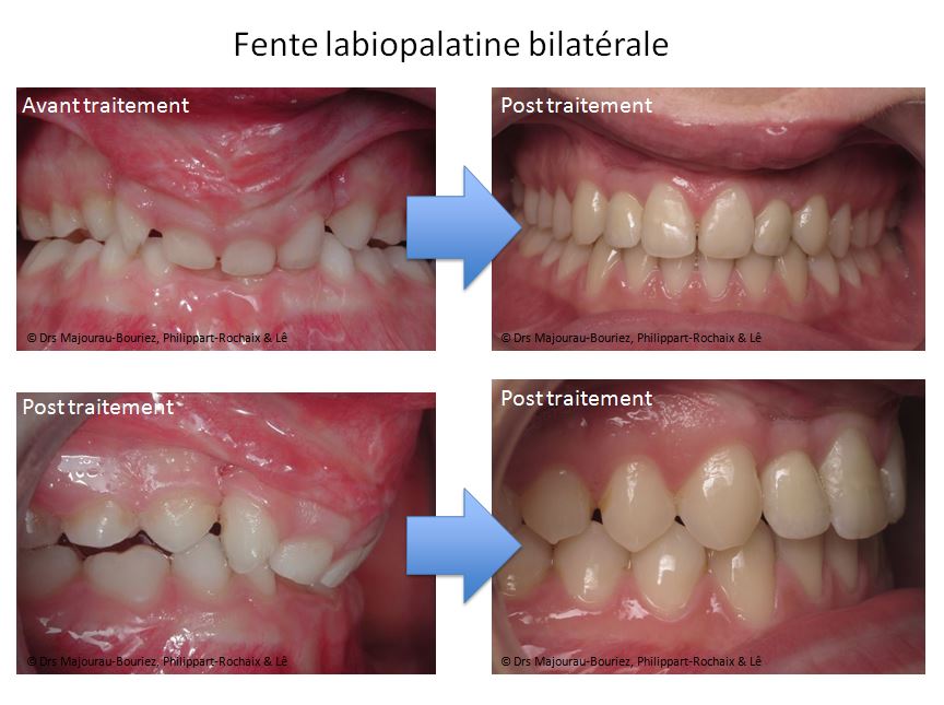 cas FLP 5bis